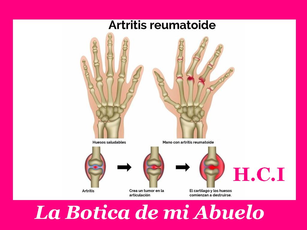 Предрасполагающие факторы ревматоидного артрита. Ревматоидный артрит факторы. Висцеральные поражения при ревматоидном артрите. Ревматоидный артрит причины возникновения. Ревматоидный артрит психосоматика.