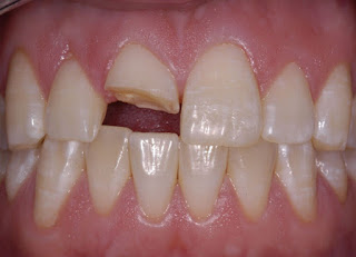 Bọc răng sứ cho răng gẫy mẻ Bọc răng sứ cho răng gẫy mẻ