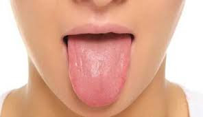 Obat Penyakit Glossitis (Peradangan pada Lidah)