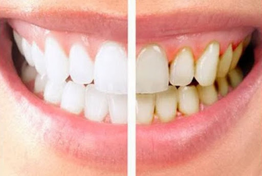 cara menghilangkan karang gigi dengan cepat 12 Cara Menghilangkan Karang Gigi Secara Alami dengan Cepat