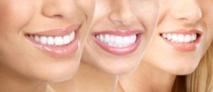 Tẩy trắng răng bằng cách nào hiệu quả?