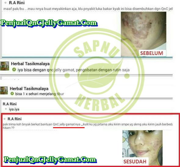 Cara Cepat Menghilangkan Keloid Di Wajah Secara Alami Cara Cepat Menghilangkan Keloid Di Wajah Secara Alami