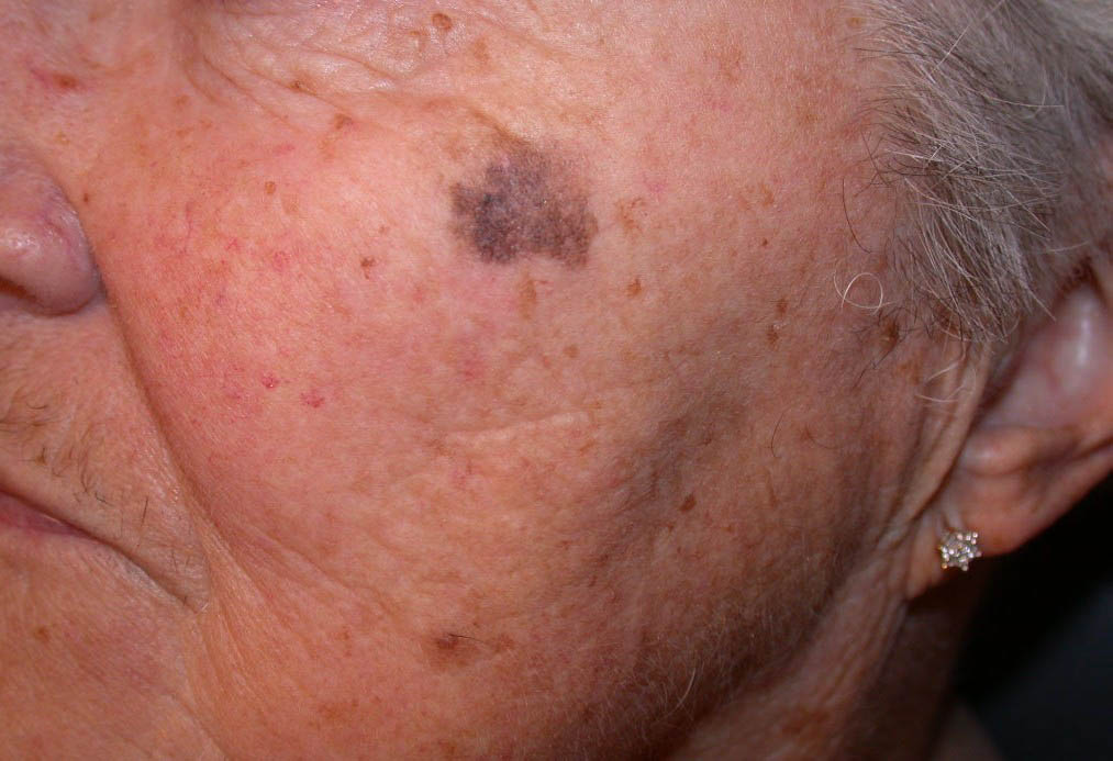 Solar Lentigo (Liver Spots) on Face, Hands - Pictures ...