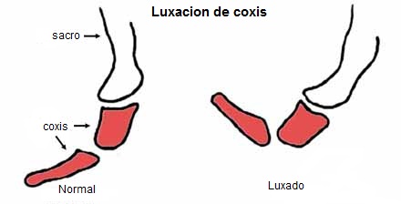Luxación de coxis una historia real Luxación de coxis una historia real