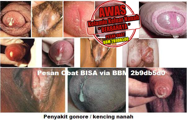 Jual Pengobatan Kelamin Keluar Nanah Yang Paling Di Cari Jual Pengobatan Kelamin Keluar Nanah Yang Paling Di Cari