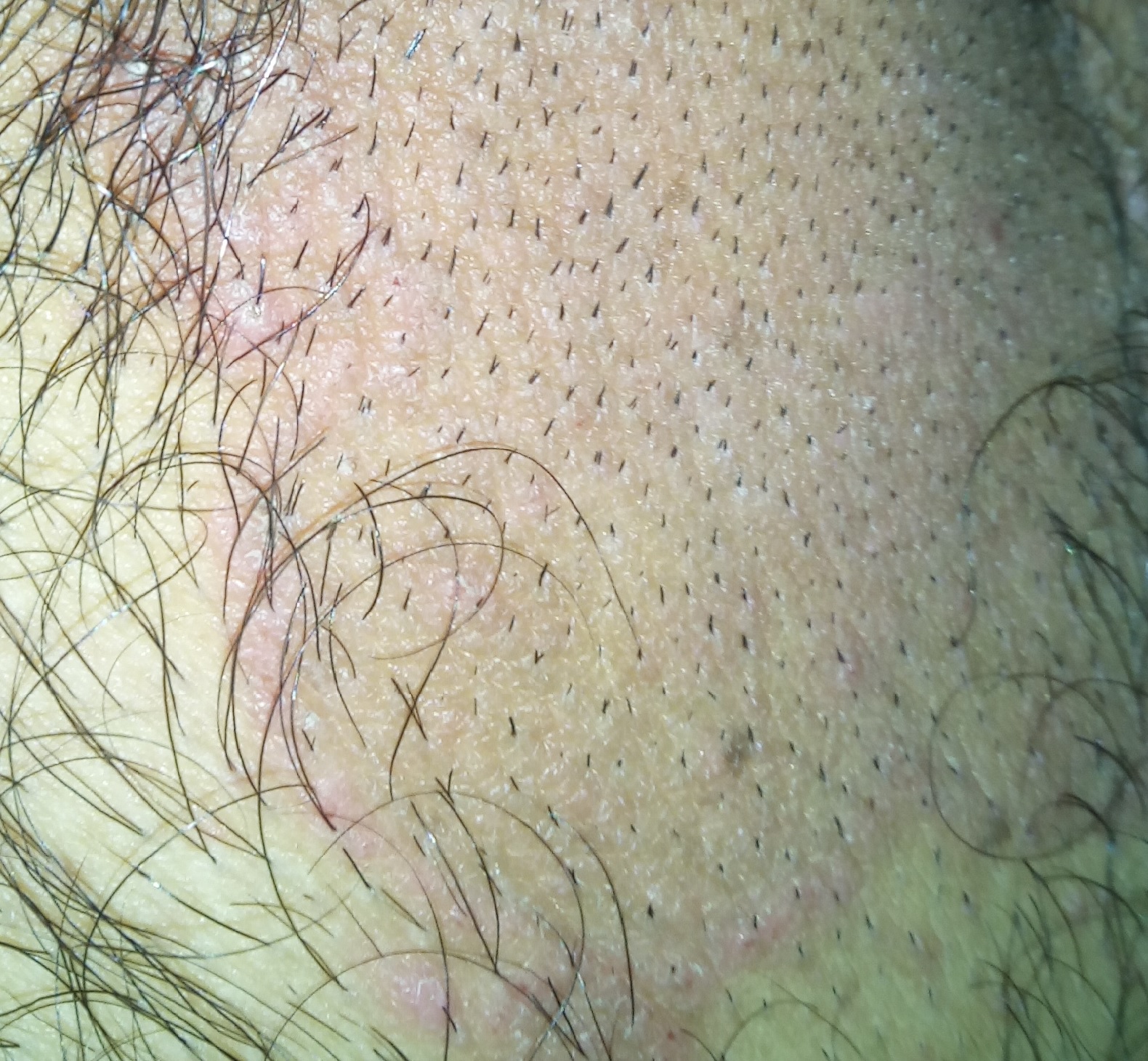 What causes irritation in the groin What causes irritation in the groin