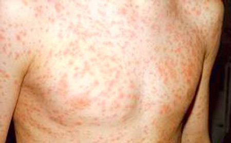 Hasil gambar untuk tanda tanda hiv pada kulit