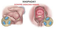 Nanah Keluar Dari Penis Apa Obatnya Nanah Keluar Dari Penis Apa Obatnya