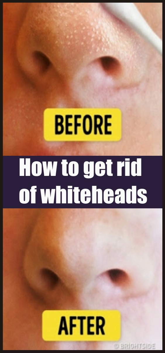 How to get rid of whiteheads note in beauty