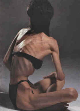 anorexia1.jpg