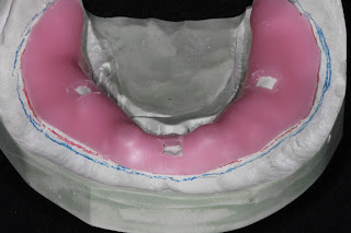 Boise Idaho Prosthodontics: Edentulous Custom Tray for PVS Impression ...