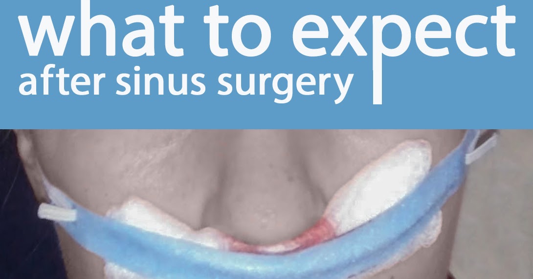 An Apel a Day What to Expect After a Sinus Surgery deviatedseptum 