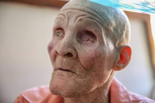 Photos: Unknown thugs chop off left hand of 75-year-old Albino man in Tanzania and disappear with it