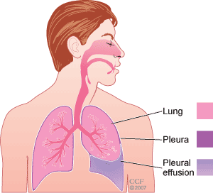 Pleural Effusion Pleural Effusion