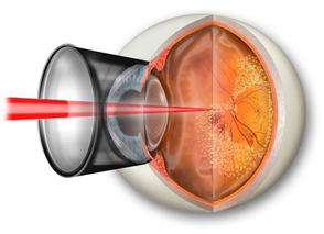 Diabetic Eye Disease - A Preventable Cause Of Vision Loss