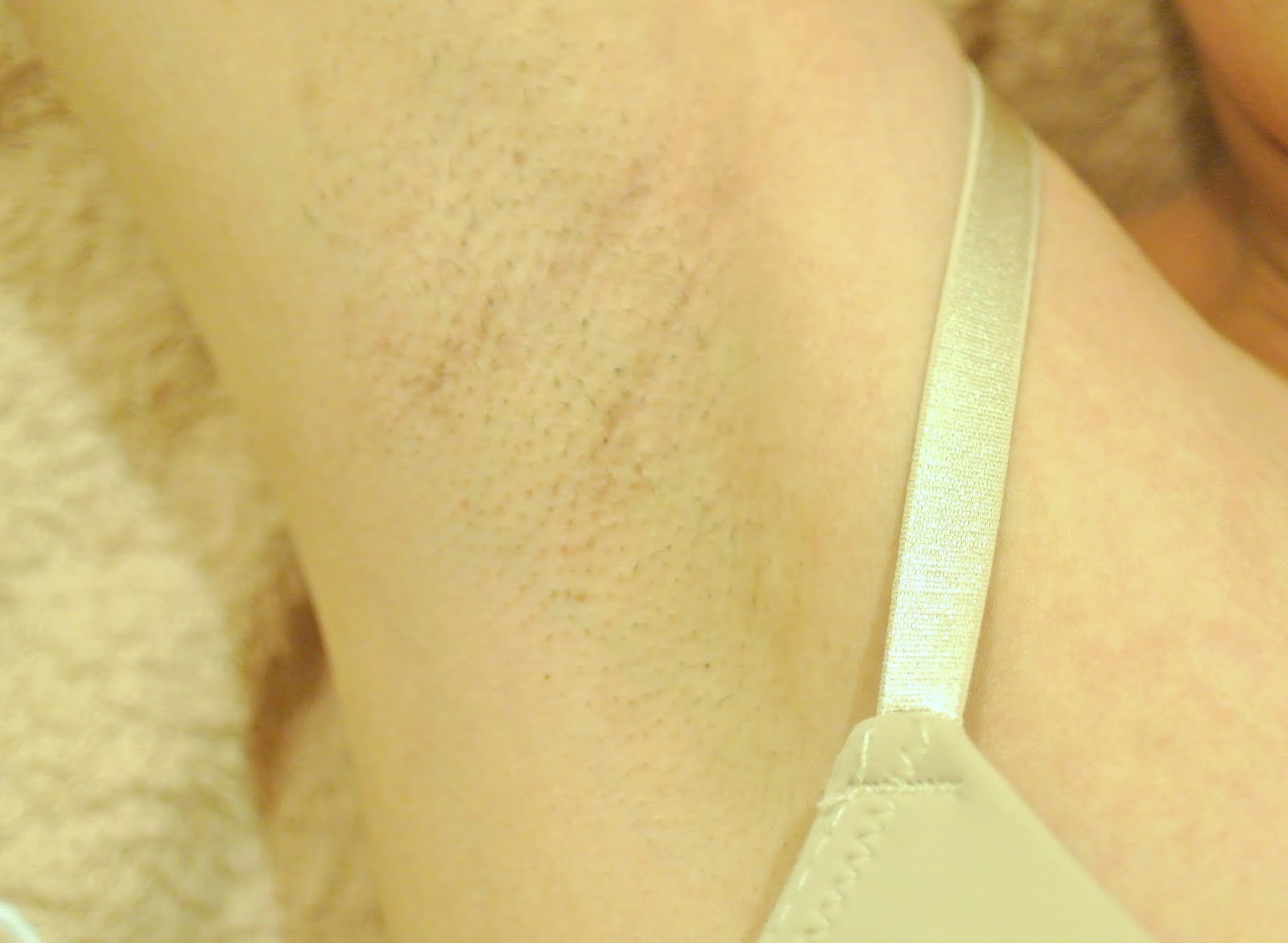Peeling Skin Under Armpit