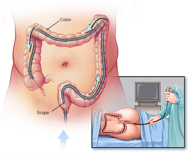Signs Of Colon Cancer In Men Signs Of Colon Cancer In Men