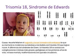 TRISOMIA 18 SINDROME DE EDWARDS DOWNLOAD TRISOMIA 18 SINDROME DE EDWARDS DOWNLOAD