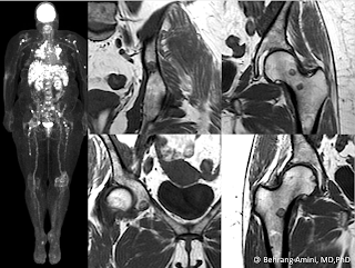 FDG PET and MRI of a patient with sarcoidosis and fat-containing bone lesions. FDG PET and MRI of a patient with sarcoidosis and fat-containing bone lesions.
