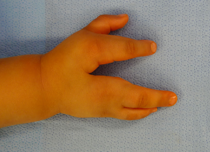 Cleft Hand Surgery | Congenital Hand and Arm Differences | Washington University in St. Louis