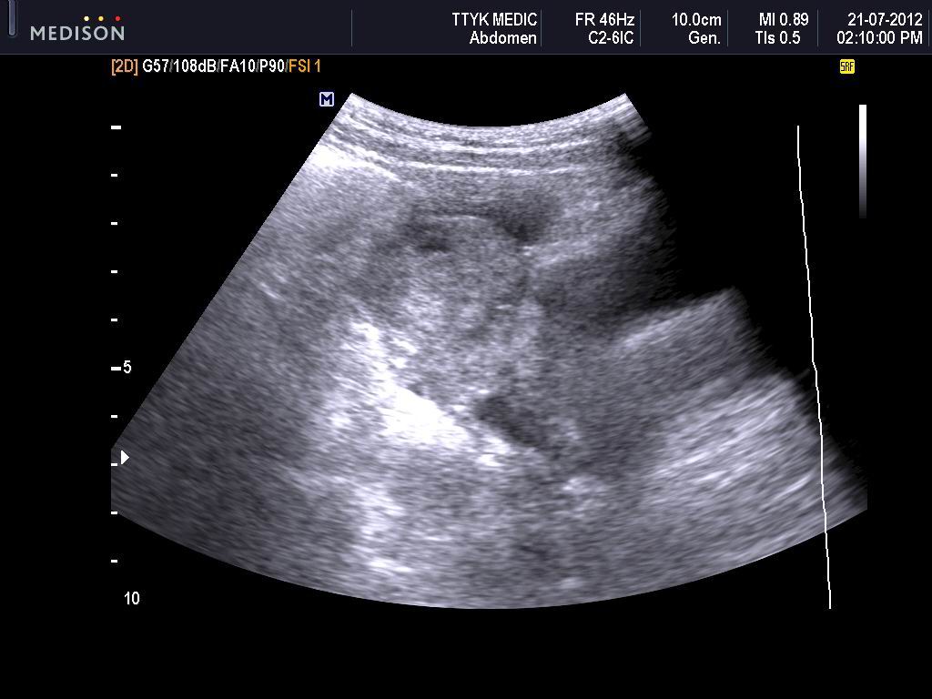 VIETNAMESE MEDIC ULTRASOUND CASE 132OVARIAN TUMORS and