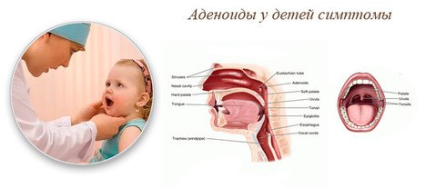 Где аденоиды у ребенка. Аденоиды у детей симптомы. Аденоиды у детей симпто.
