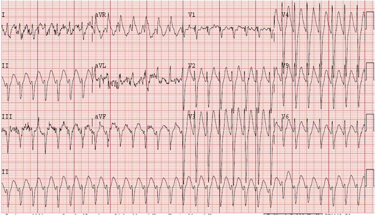 Entree Kibbles The Term of My Heart Condition Supraventricular