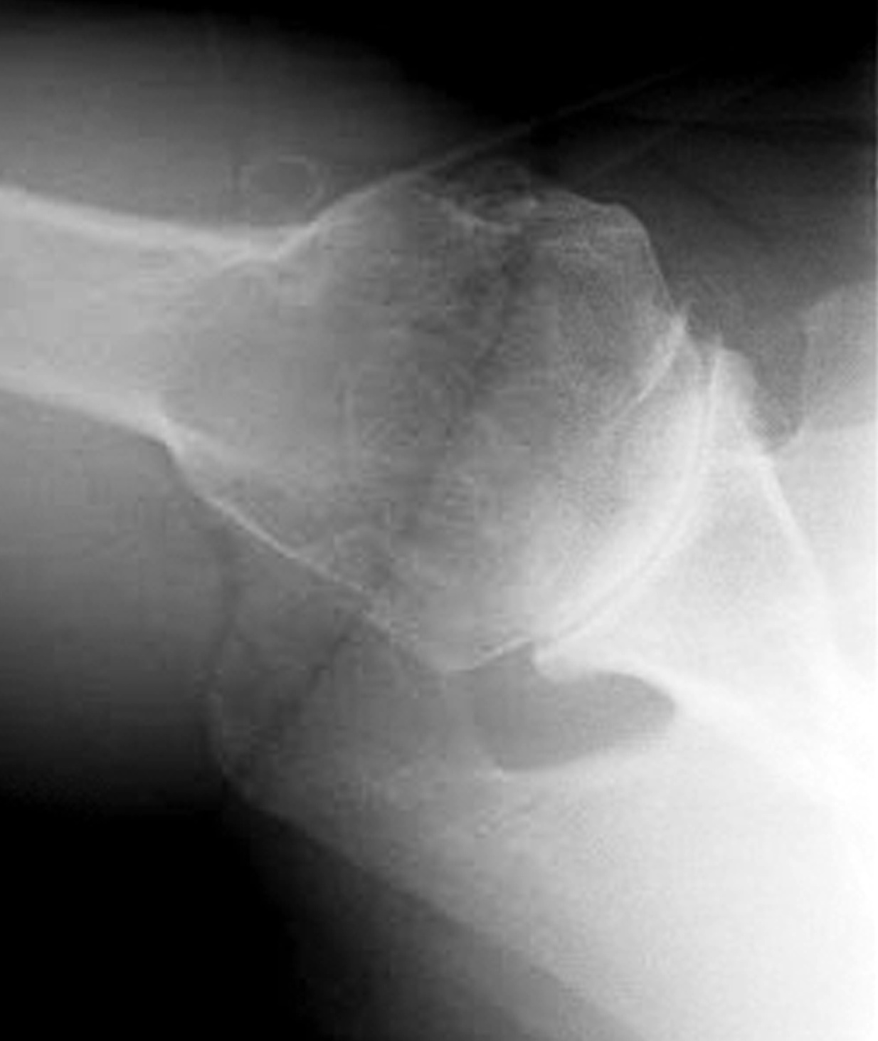UW Shoulder and Elbow Academy Anatomy of the glenoid on axillary x