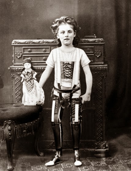 Vintage black and white photo of a girl with two prosthetic legs standing for a portrait.