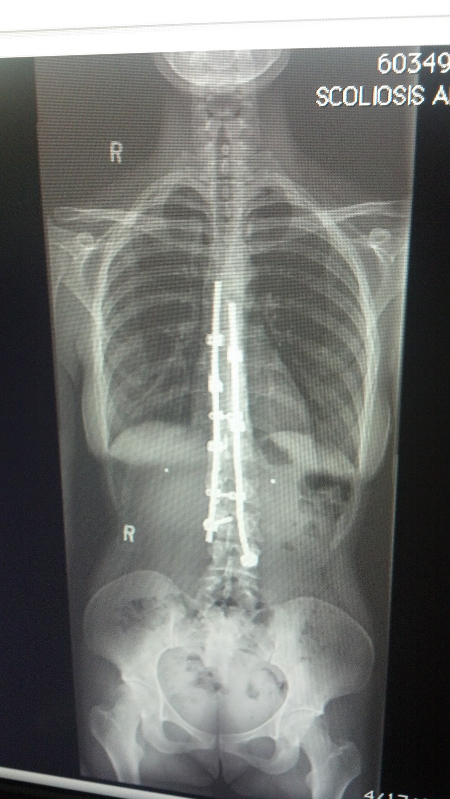 Dr. Lloyd Hey's Blog Scoliosis and Spine Care, Aviation