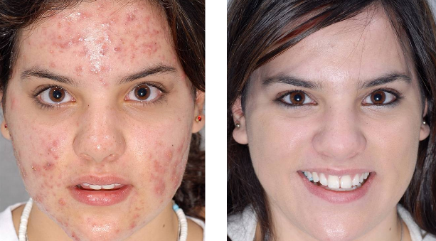 bilmek Auckland seviye I wash my face several times a day why still i have acne. | Weight Loss and Fitness bilmek Auckland seviye I wash my face several times a day why still i have acne. | Weight Loss and Fitness