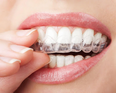 Niềng răng Invisalign hiệu quả tại nha khoa uy tín