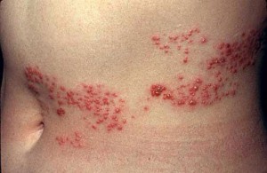 Obat Ampuh Herpes di Kepala dan Perut Obat Ampuh Herpes di Kepala dan Perut