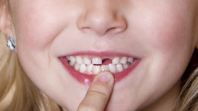 Cấy ghép implant điều trị hiệu quả mất răng