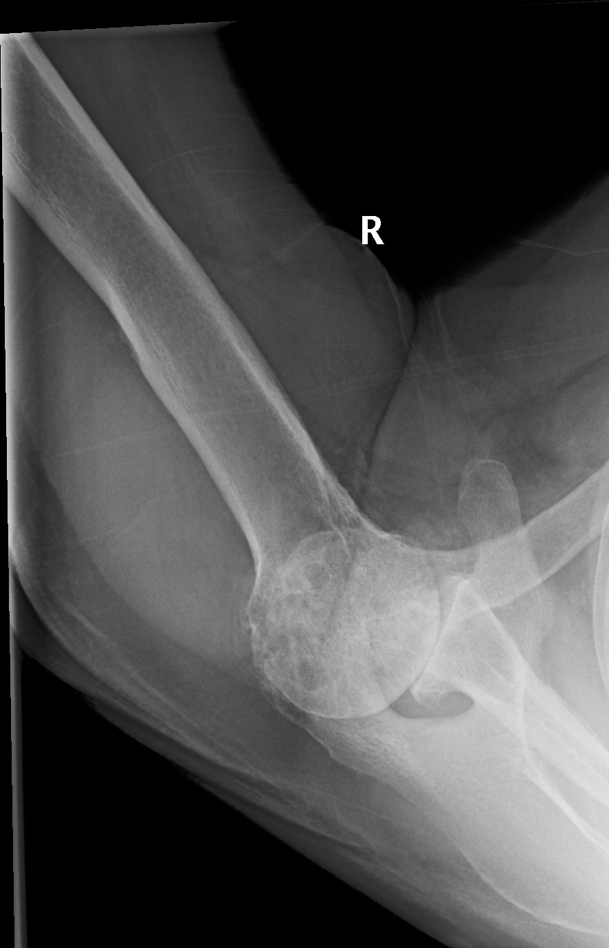 UW Shoulder and Elbow Academy Rotator cuff tear arthropathy and the