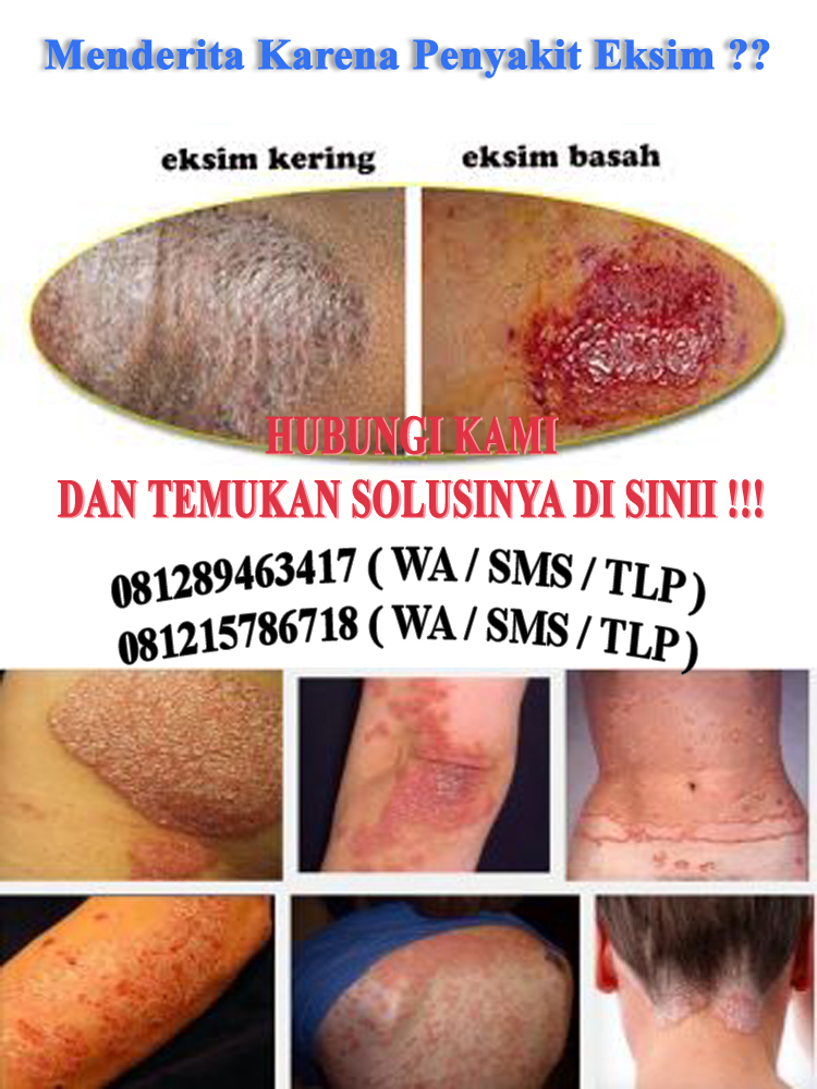 Obat Penyakit Kulit De Nature Asli Contoh Salep eksim di apotik umum