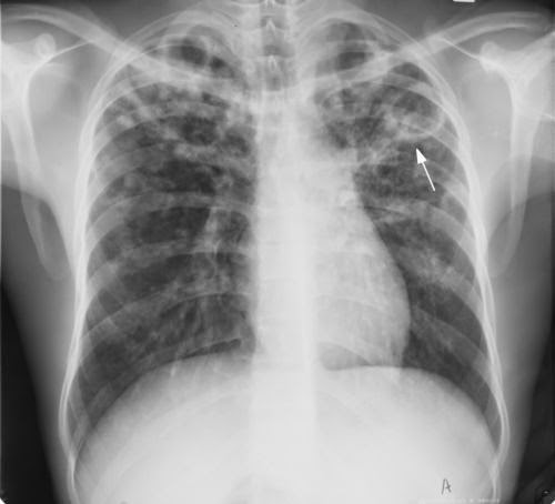 koch pulmonum