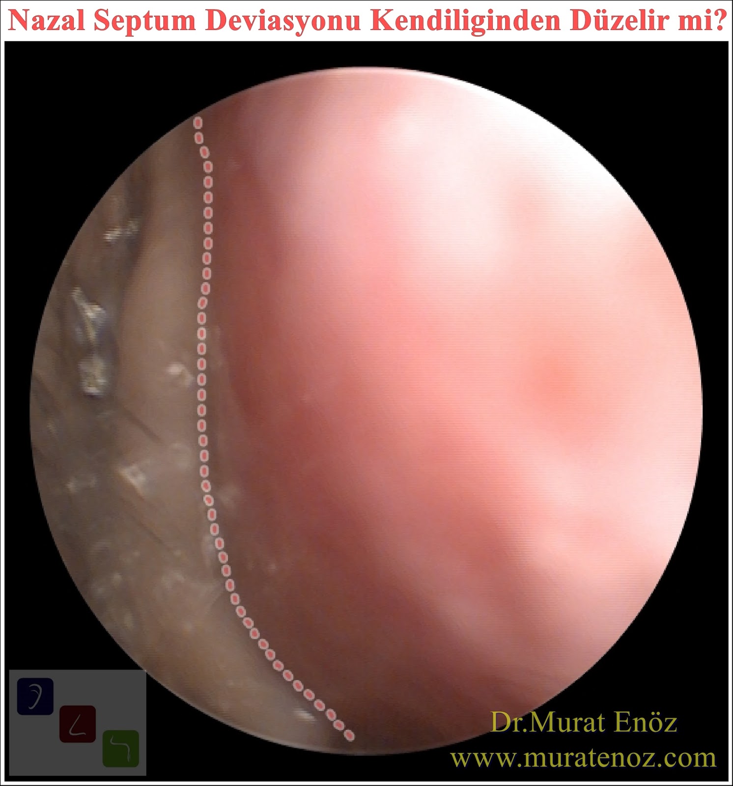 Nazal Septum Deviasyonu Kendiliğinden Düzelir mi? Nazal Septum Deviasyonu Kendiliğinden Düzelir mi?
