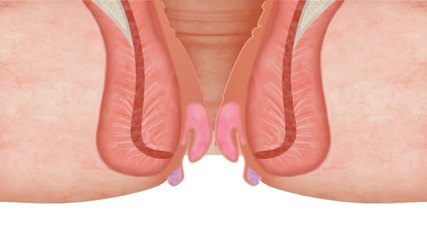 obat wasir suppositoria