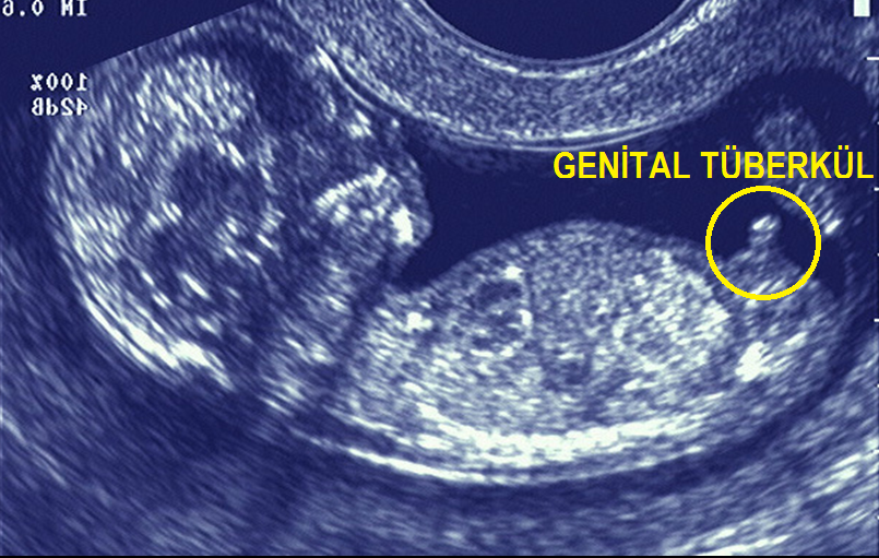 GEBELİĞİN İLK ÜÇ AYINDA CİNSİYET TAYİNİ Jinekoloji Gebelik Hesaplama