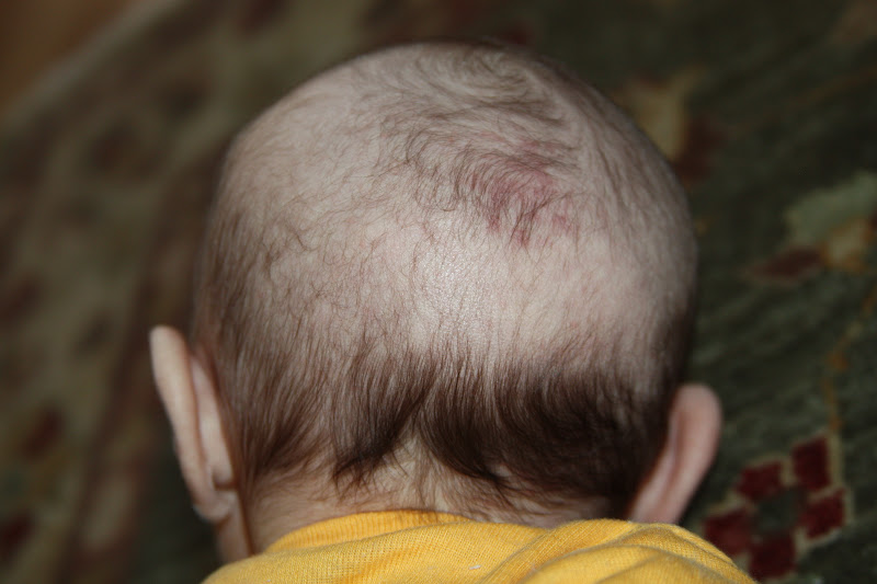 The Evolving Elseners Balding Baby