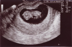 10 haftalık gebelik görüntüsü