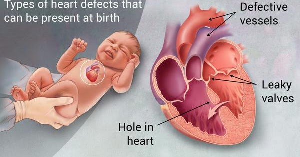 what is congenital defects