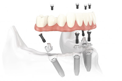Thời gian trồng răng implant sau nhổ răng