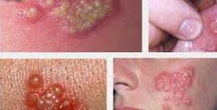 https://2.bp.blogspot.com/-1YvFAh7EeX0/WQGxB1j5chI/AAAAAAAAAdc/nO8jMDsB-doryxUu_4UGpNl3Cd_nqMSCgCLcB/s1600/Ciri-Ciri-Penyakit-Herpes.jpg