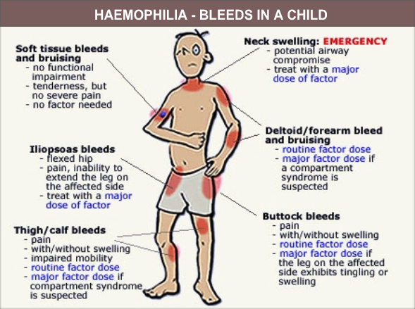 An Illustration of Haemophilia Bleeds