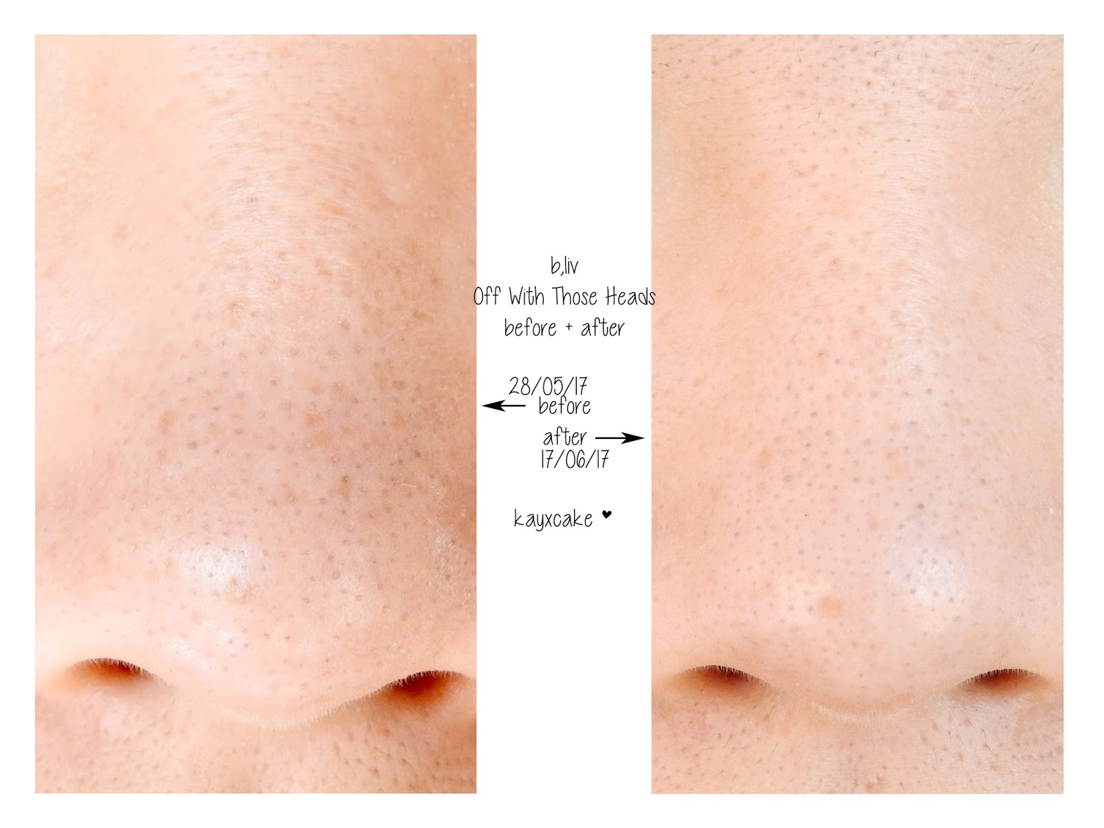 PORES, BLACKHEADS & OILY SKIN ♡ Introducing b.liv Kay Cake Beauty