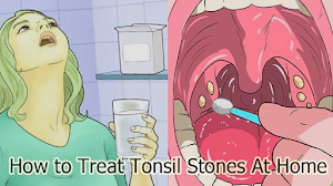 How to Treat Tonsil Stones At Home How to Treat Tonsil Stones At Home