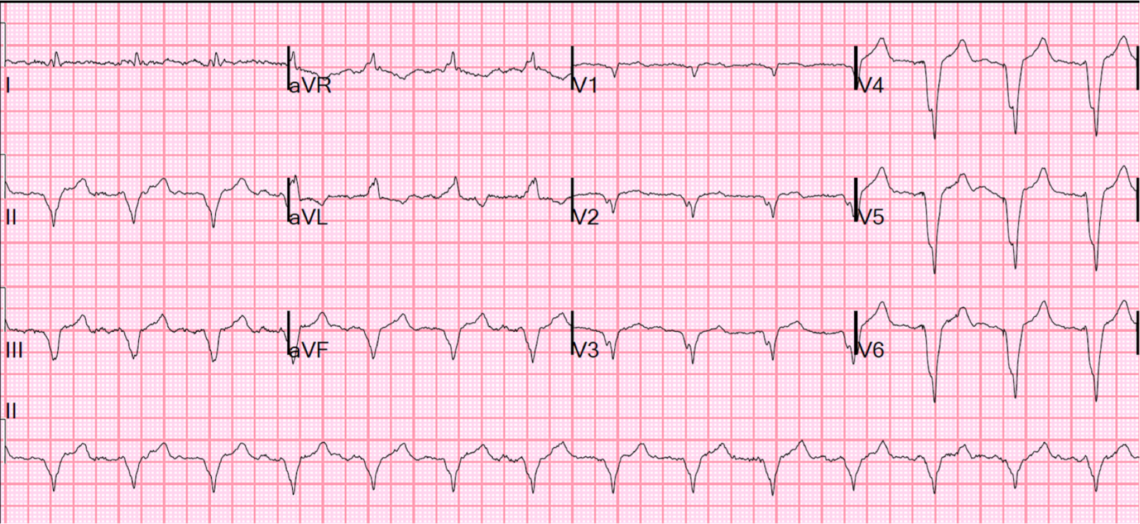 Single chamber pacemaker ecg