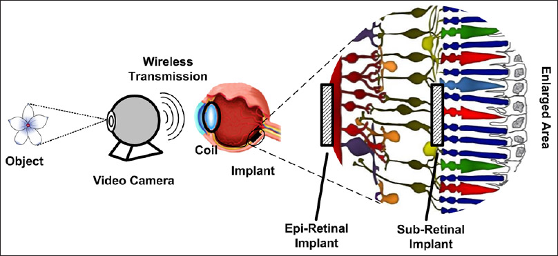 Visual prosthesis picture